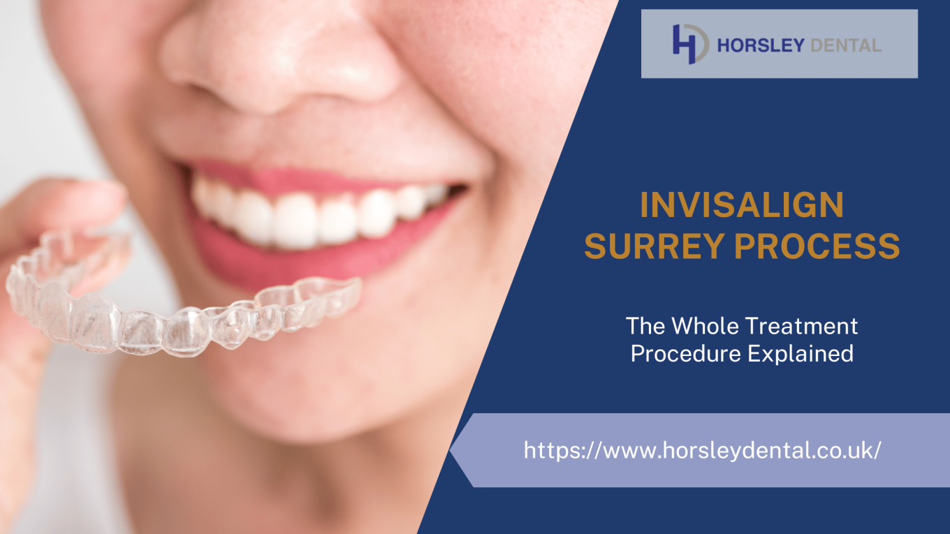 Invisalign Surrey Process: The Whole Treatment Procedure Explained